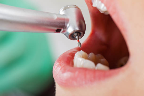 Best Emergency Wisdom Tooth Extraction in Tuttle, OK